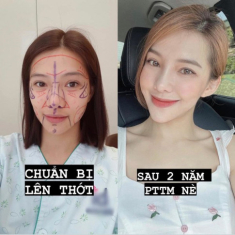 Lưu Đê Ly đánh đổi vẻ đẹp tự nhiên thành nhân tạo, kết quả như thế này đây