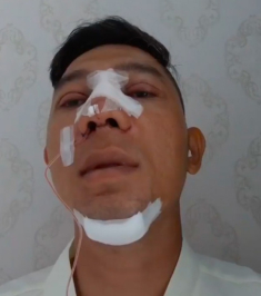 Những chiếc mí mắt sưng phù hậu dao kéo làm sao Việt hoang mang