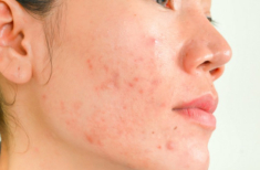 Dùng BHA chống lão hoá nhưng bị bùng mụn viêm và mụn bọc là do thiếu “đồ chơi đi kèm”