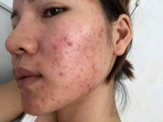 Dùng vitamin C trị thâm: da thêm mụn, không đều màu là do bạn chưa hiểu rõ serum mình dùng