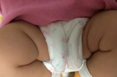 Mẹ phát hiện ngấn 2 bên chân con không đối xứng, BS kết luận: Chữa nhanh còn kịp!