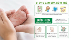 Phát hiện và can thiệp kịp thời trẻ bị dị ứng đạm sữa bò, giúp trẻ phát triển khỏe mạnh