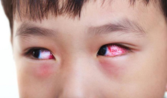 Trẻ bị đau mắt đỏ kiêng gì và ăn gì nhanh khỏi?