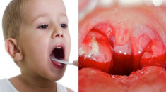 Trẻ bị viêm amidan phải xử lý như thế nào?