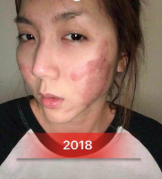 Yên ắng hậu ly hôn, Ngọc Quyên bất ngờ đăng ảnh với gương mặt biến dạng nhận không ra