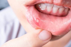Bé bị tay chân miệng uống thuốc gì?