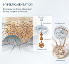 Serum giảm nám hiệu quả nhờ ức chế enzyme đứng đầu chuỗi sản sinh melanin