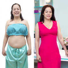 Hành trình U45 thay đổi vóc dáng nhờ hút mỡ Lipo PAL-Extra