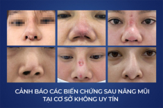 Ths.Bs Vũ Quang giải cứu hàng loạt ca mũi hỏng