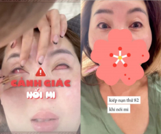 Beauty Blogger bị bỏng khi đi nối mi, giác mạc thành từng lỗ: Lời cảnh tỉnh cho chị em