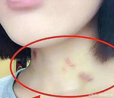 Thấy trên cổ con gái 15 tuổi có vết bầm đỏ, biết lý do người bố nổi giận nhưng sau đó liền im bặt khi đứa trẻ lên tiếng