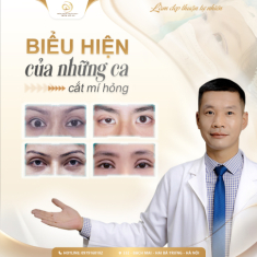 Phẫu thuật chỉnh sửa lại mí mắt do cắt mí lỗi hỏng, phức tạp và khó khăn