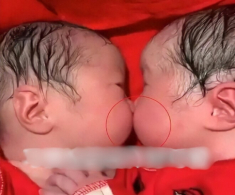 Cặp sinh đôi bám chặt lấy nhau khi mới chào đời, y tá không thể tách rời mà phải thốt lên: “Thật hiếm gặp”