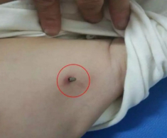 Con bị côn trùng cắn, một hành động của người mẹ suýt chút nữa khiến đứa trẻ ra đi mãi mãi