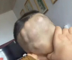 Con đi chơi về mẹ phát hiện đầu bé mọc nhiều khối u lớn như hạt óc chó, đến bệnh viện khám liền thất kinh