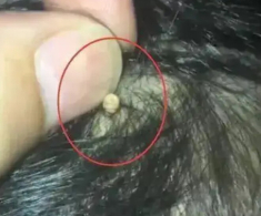 Con kêu đau, mẹ bàng hoàng khi phát hiện “hạt kê” dính chặt ở da đầu, BS nói “Đó là thứ đáng sợ”
