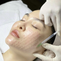 Công nghệ cấy Meso không đau, không bầm: Xu hướng mới được dân công sở mê mẩn