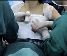 Mẹ thấy ngực con gái 13 tuổi sưng đỏ, đưa đến bệnh viện bác sĩ phát hiện nhiều vụn giấy kỳ lạ