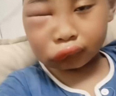 Gửi con về quê nghỉ hè với ông bà, ngày về đón mẹ tá hoả khi mặt đứa trẻ biến dạng