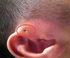 Mẹ phát hiện gần tai con xuất hiện một lỗ sâu khác thường liền tò mò bóp thử, không ngờ bác sĩ yêu cầu phẫu thuật ngay