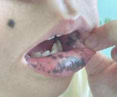 Mẹ phát hiện môi con gái 10 tuổi có nhiều đốm đen kỳ lạ, đến bệnh viện kiểm tra thì kinh hãi nghe bác sĩ nói