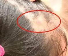 Mẹ phát hiện trên đầu con xuất hiện một lỗ sâu kỳ lạ liền đưa đi khám, đến bệnh viện bác sĩ nói: “Đứa trẻ quá may mắn”