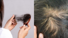 Càng ăn nhiều 2 thứ này tóc càng rụng tơi tả, sau vài năm trông già đi nhanh vì hói đầu