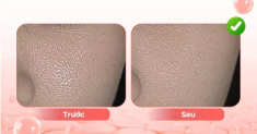 Điều trị lão hóa sắc tố da tuổi trung niên