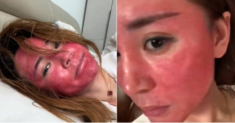 Mặt sưng đỏ, biến dạng sau 22 năm không tẩy trang