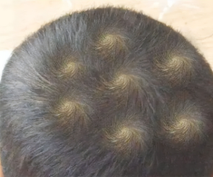 Mẹ phát hiện trên đầu con xuất hiện 7 vòng xoáy kỳ lạ, lo lắng đưa đến viện khám, bác sĩ thốt lên: Thật hiếm gặp!