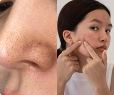 Muốn trị dứt điểm mụn đầu đen? Tránh xa 3 thực phẩm này nếu không muốn công sức skincare đổ sông đổ biển