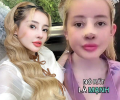 Ngân 98 ngất xỉu khi tháo sụn mũi giả, sau 12 lần sửa giờ phải lấy mỡ từ mông để cấy lên mũi