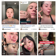 Phương pháp trị mụn bằng tỏi “hot” trên TikTok có thực sự hiệu quả hay hại da? Bác sĩ da liễu chỉ cách làm đúng nhất