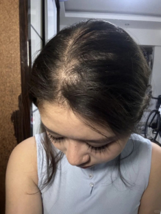 Tại sao tóc rụng không ngừng, ngày càng mỏng? Mách nàng 5 cách khắc phục rụng tóc hiệu quả, cho mái tóc dày đẹp