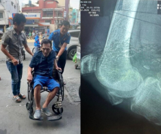 Thông tin mới nhất về tình hình sức khỏe của Thương Tín: 1 chân không thể hồi phục, chưa thể phẫu thuật vì rất yếu
