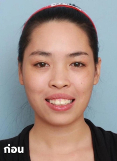 Nhan sắc hiện tại của hot girl từng “lột xác” nhờ phẫu thuật thẩm mỹ