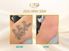 Xóa hình xăm không để lại sẹo và bí mật đằng sau