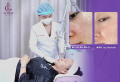 Giải mã sức hút Deep FX Laser: Công nghệ thu nhỏ lỗ chân lông thế hệ mới đang “gây bão” tại LG Clinic